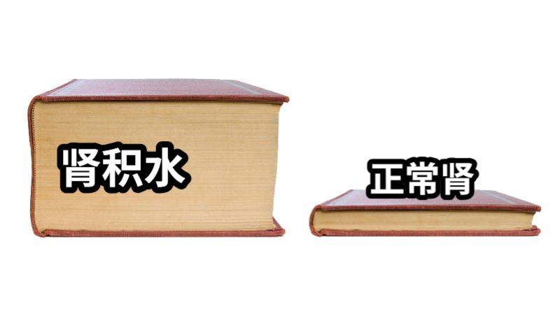 肾积水正常肾